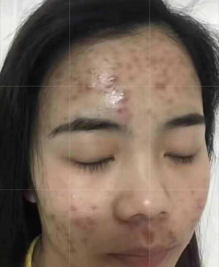 专业去痘无效退款