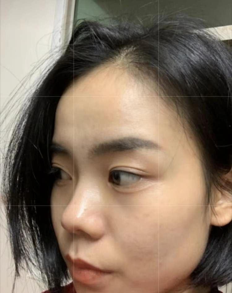 专业去痘无效退款