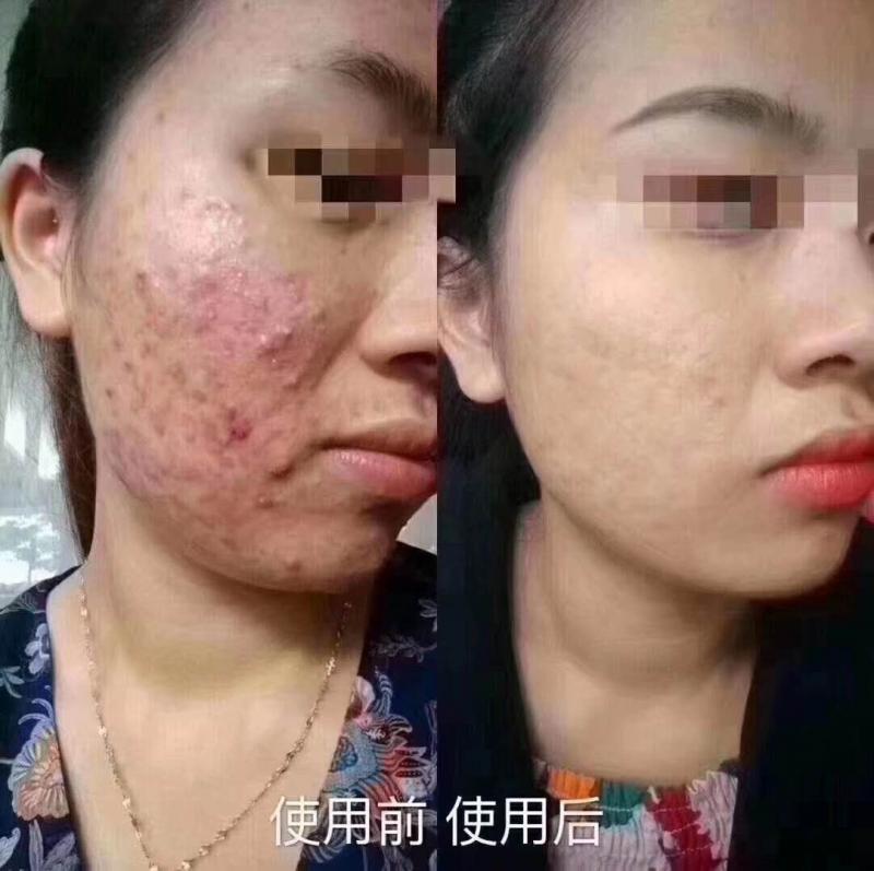 专业去痘无效退款
