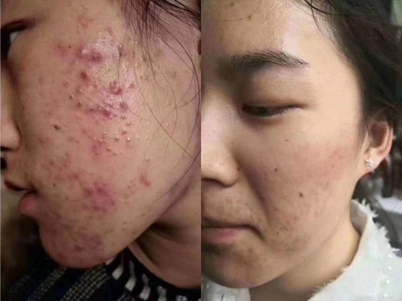 专业去痘无效退款