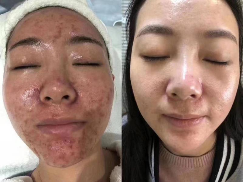 专业去痘无效退款